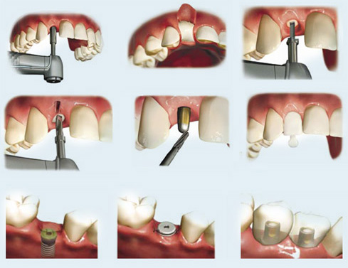 teeth implant